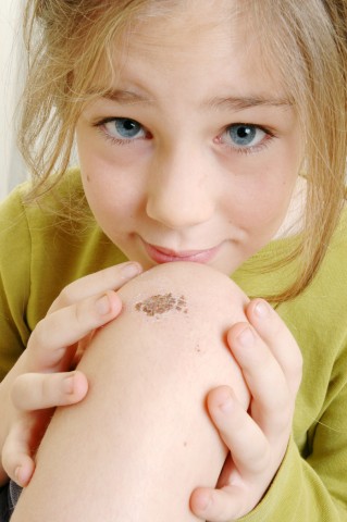 A Little Girl Who Skinned Her Knee