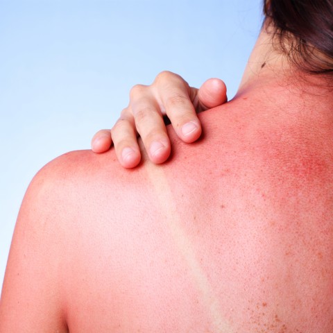 A Woman's Sunburnt Back.